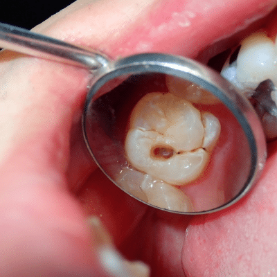 Tooth with cavity, displaying dental issues