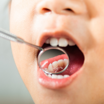 Dentist mirror tool inside a kid's mouth, examining teeth, representing early orthodontic treatment